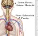 NII to host global symposium on extra-pulmonary Tuberculosis