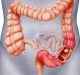 A new automated system to detect colorectal cancer