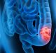 Scientists Discover a New Way to Detect Early Colon Cancer