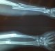 Study May Help Find New Way to Aid Bone Regeneration